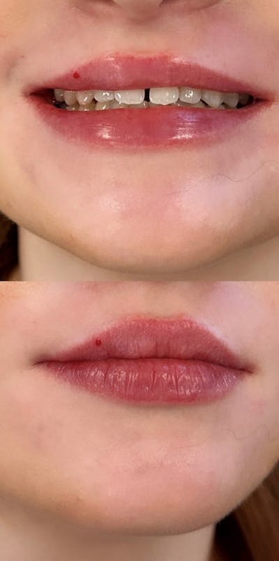 Juvéderm® Before & After Gallery - Patient 138916 - Image 2