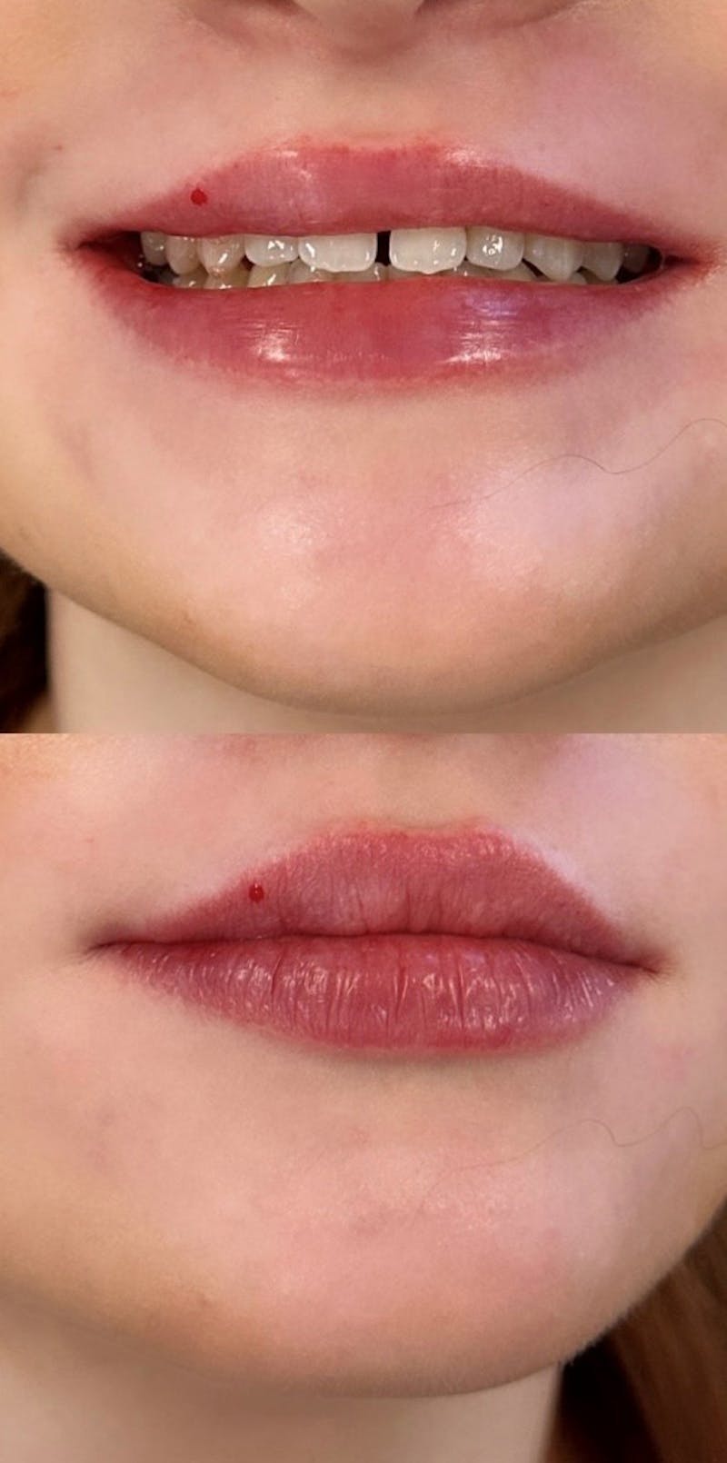 Juvéderm® Before & After Gallery - Patient 138916 - Image 2