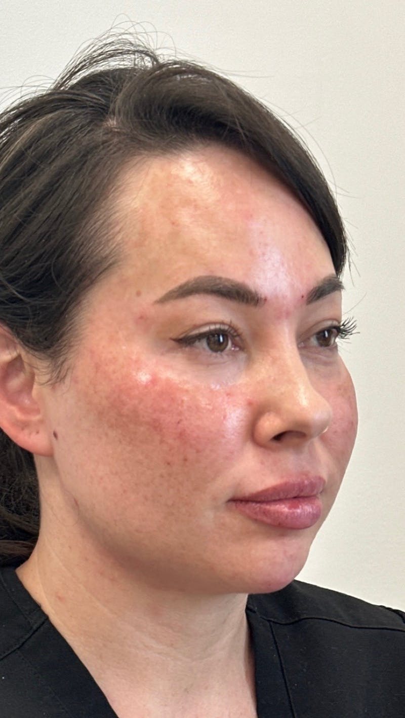 Cheek Filler Before & After Gallery - Patient 272870 - Image 2