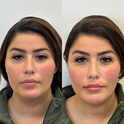Juvéderm® Before & After Gallery - Patient 111134 - Image 1
