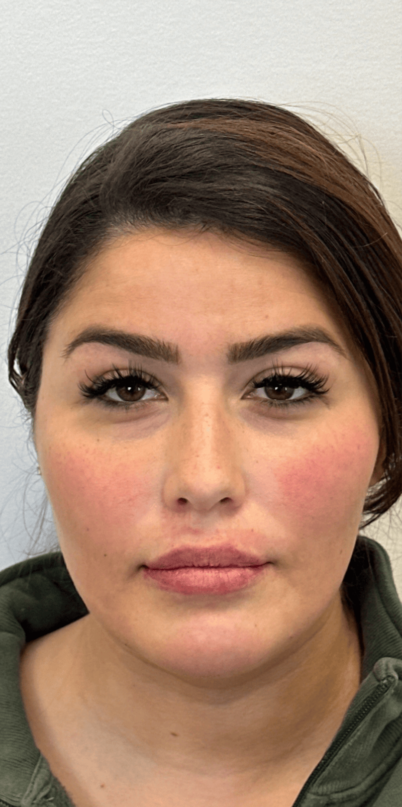 Jawline Filler Before & After Gallery - Patient 235813 - Image 2