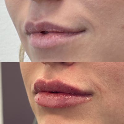 Juvéderm® Before & After Gallery - Patient 280411 - Image 1
