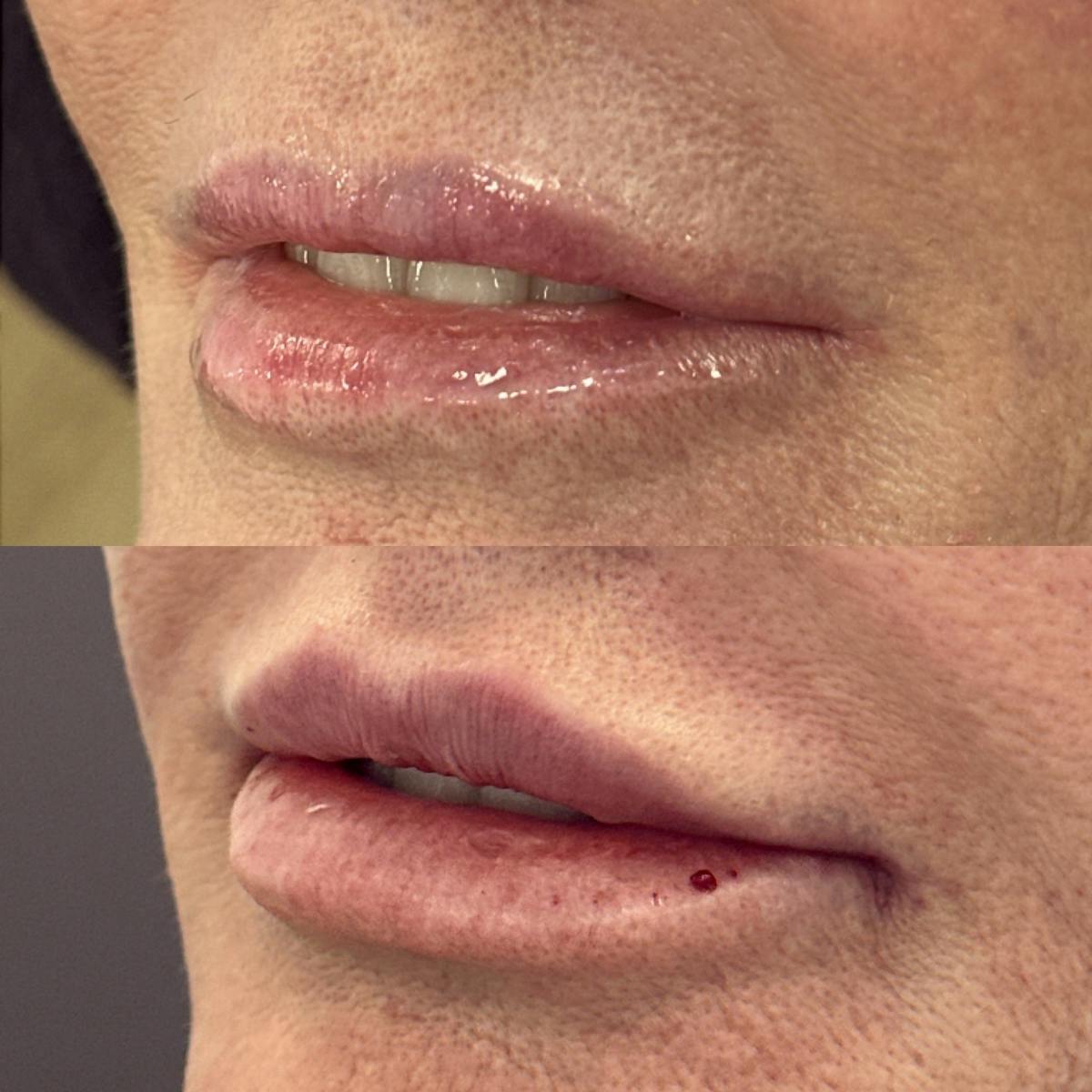 Juvéderm® Before & After Gallery - Patient 408833 - Image 1