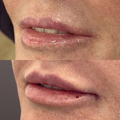 Juvéderm® Before & After Gallery - Patient 408833 - Image 1