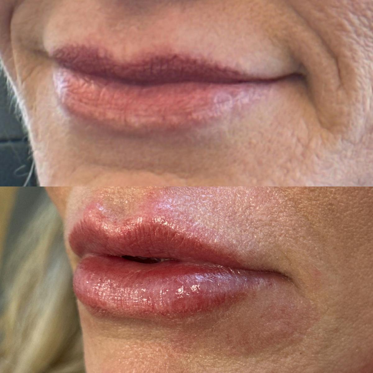 Juvéderm® Before & After Gallery - Patient 253557 - Image 1