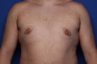 Gynecomastia (Male Breast Reduction) Before & After Gallery - Patient 433178 - Image 2