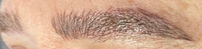 Eyebrow Microblading Before & After Gallery - Patient 254238 - Image 2
