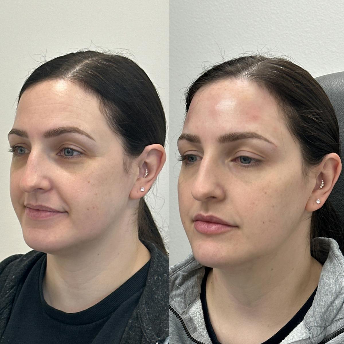 BOTOX Before & After Gallery - Patient 216588 - Image 1