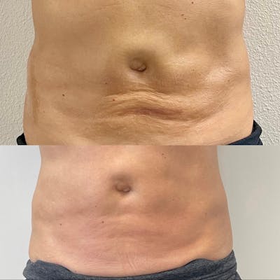 Morpheus8® Before & After Gallery - Patient 393341 - Image 1