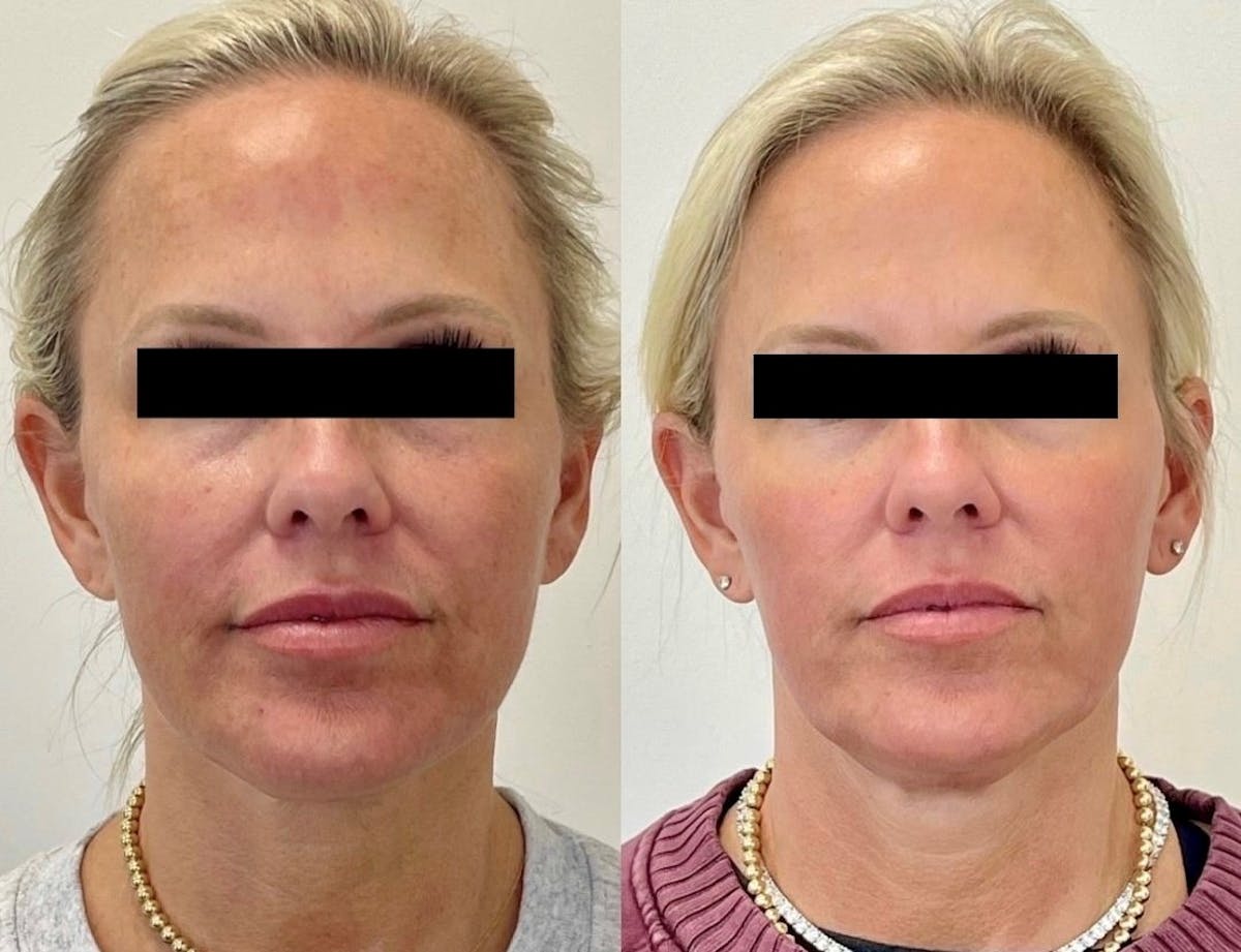 Sciton® Halo Before & After Gallery - Patient 314800 - Image 1