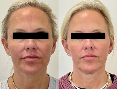 Sciton® Halo Before & After Gallery - Patient 314800 - Image 1