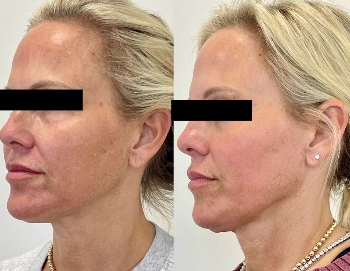 Sciton® Halo Before & After Gallery - Patient 314800 - Image 2