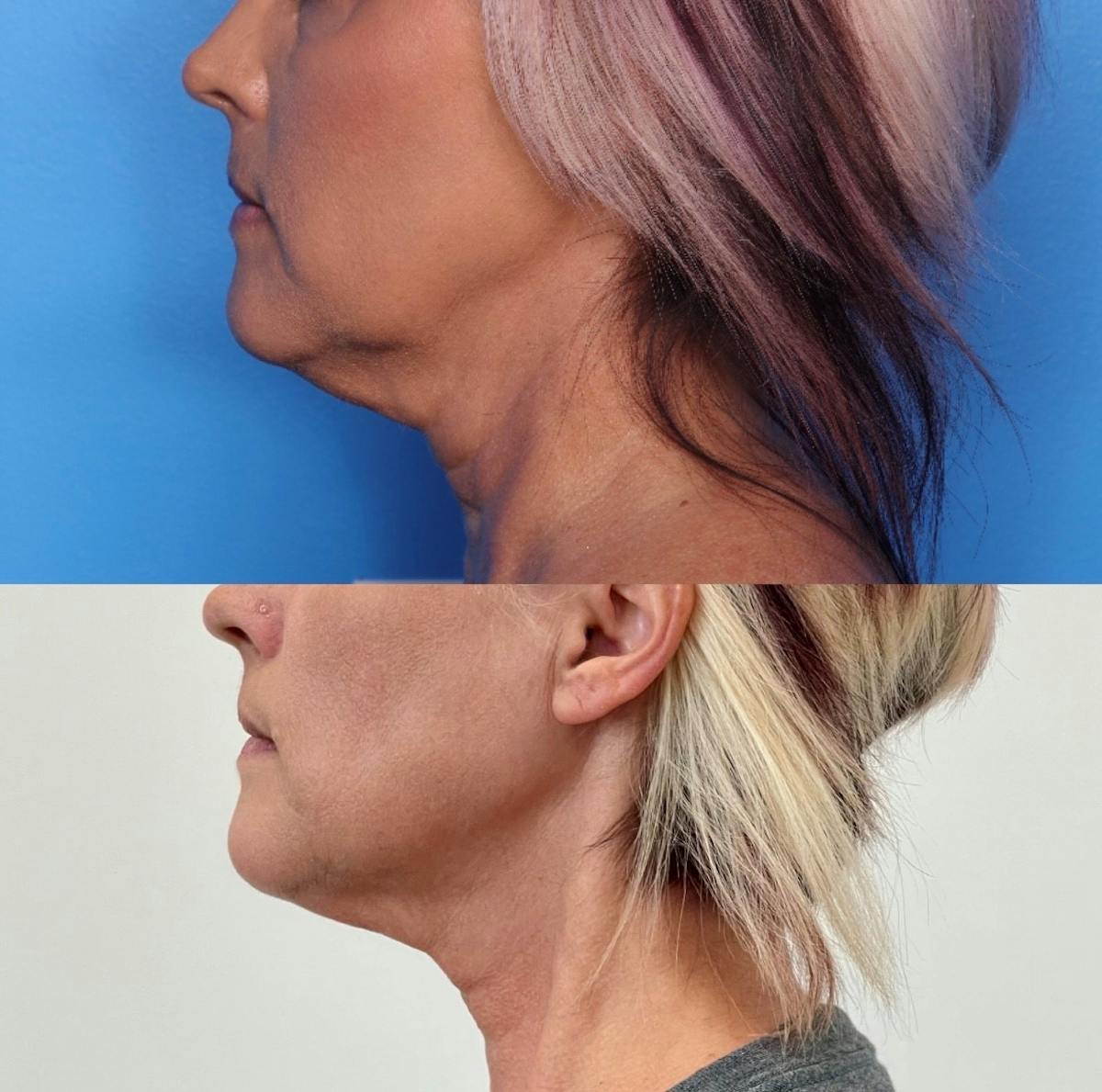 Morpheus8® Before & After Gallery - Patient 379054 - Image 1