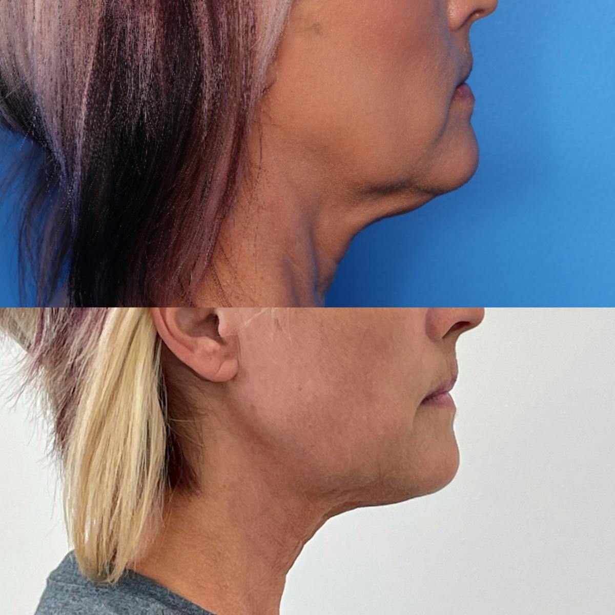 Morpheus8® Before & After Gallery - Patient 379054 - Image 2
