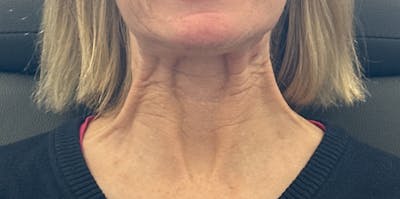 BOTOX Before & After Gallery - Patient 716154 - Image 1