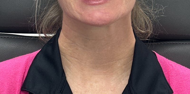 BOTOX Before & After Gallery - Patient 716154 - Image 2