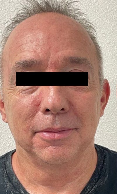 Sciton® Halo Before & After Gallery - Patient 184401 - Image 1