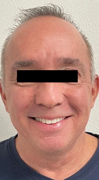 Sciton® Halo Before & After Gallery - Patient 184401 - Image 2