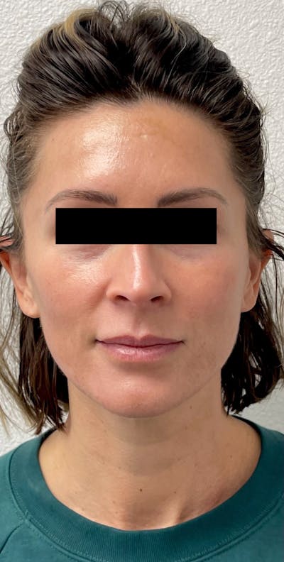 Sciton® Halo Before & After Gallery - Patient 332651 - Image 1