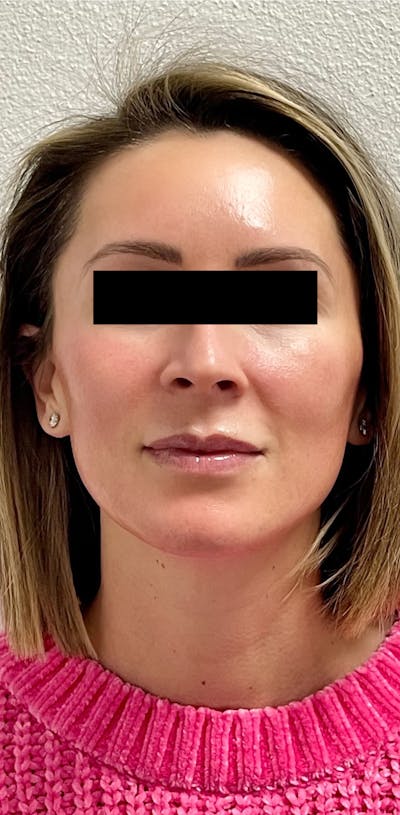 Sciton® Halo Before & After Gallery - Patient 332651 - Image 2