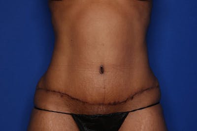 Mommy Makeover Before & After Gallery - Patient 254210 - Image 2