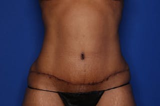 Tummy Tuck Before & After Gallery - Patient 396916 - Image 2