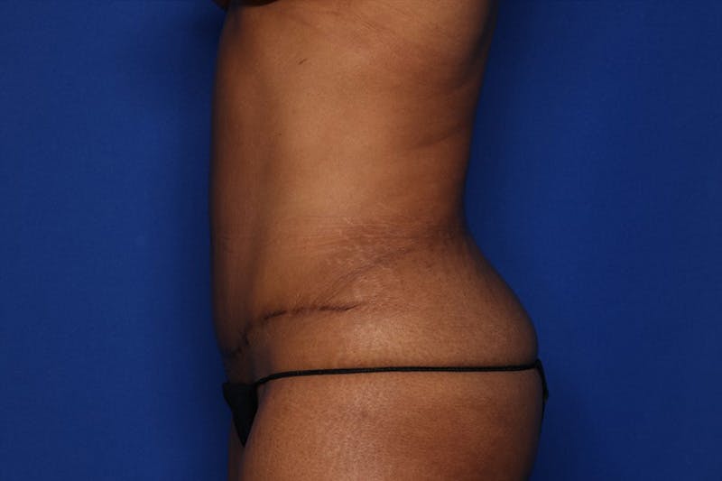 Tummy Tuck Before & After Gallery - Patient 396916 - Image 4