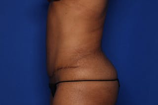Tummy Tuck Before & After Gallery - Patient 396916 - Image 4