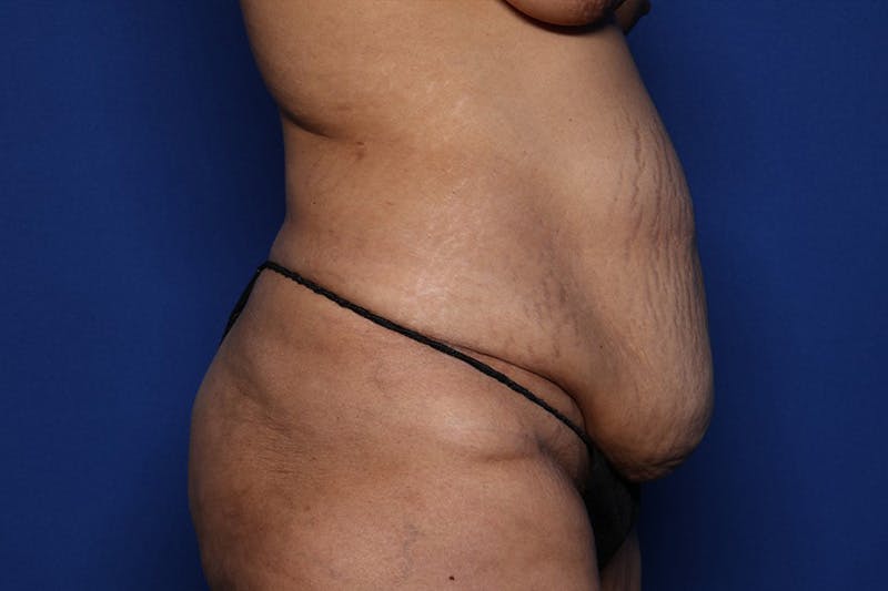 Tummy Tuck Before & After Gallery - Patient 418161 - Image 3