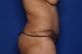 Tummy Tuck Before & After Gallery - Patient 418161 - Image 4