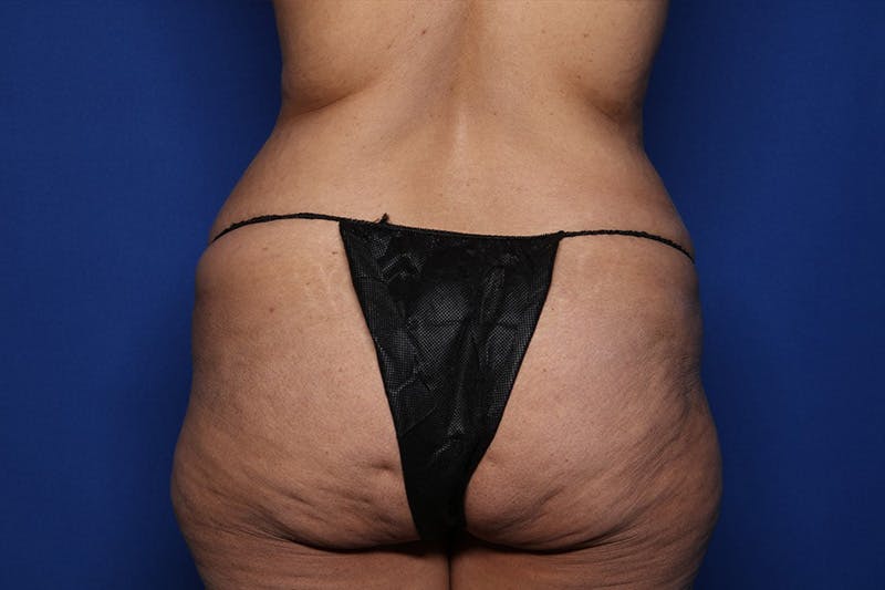 Tummy Tuck Before & After Gallery - Patient 418161 - Image 5