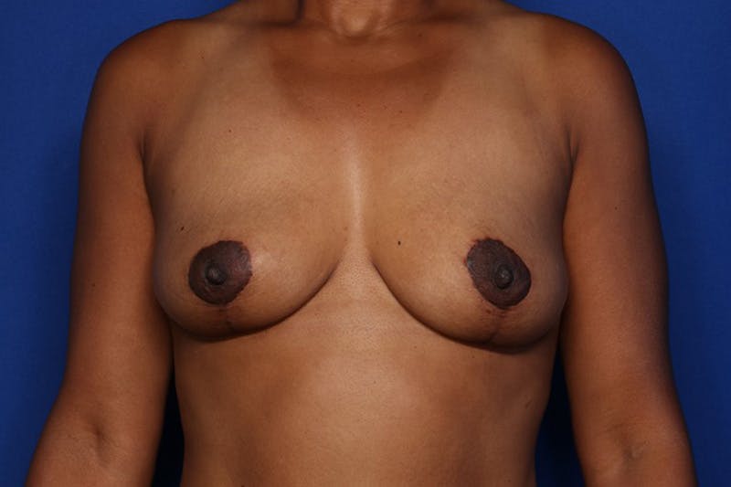 Breast Lift Before & After Gallery - Patient 211046 - Image 2