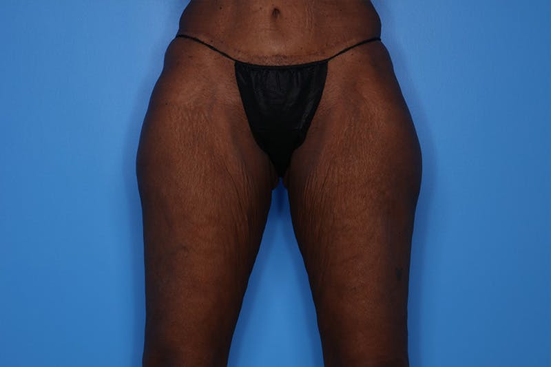 Thigh Lift Before & After Gallery - Patient 424363 - Image 1