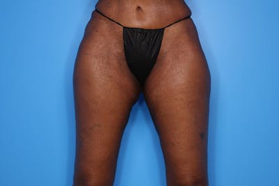 Thigh Lift Before & After Gallery - Patient 424363 - Image 2