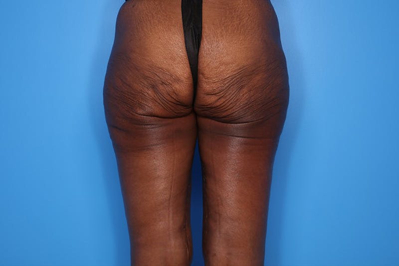 Thigh Lift Before & After Gallery - Patient 424363 - Image 4
