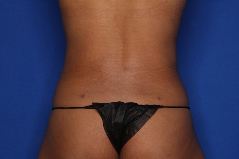 Liposuction Before & After Gallery - Patient 119152 - Image 6