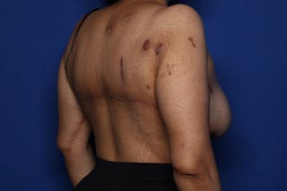 BodyTite™ Before and After Before & After Gallery - Patient 110279 - Image 4