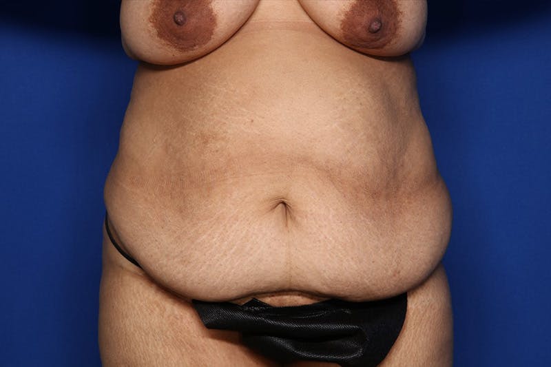 Liposuction Before & After Gallery - Patient 175672 - Image 1