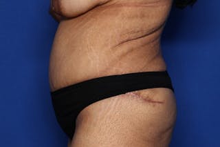 Liposuction Before & After Gallery - Patient 175672 - Image 4