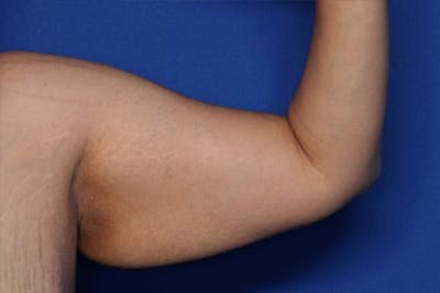 Arm Lift Before & After Gallery - Patient 349618 - Image 1