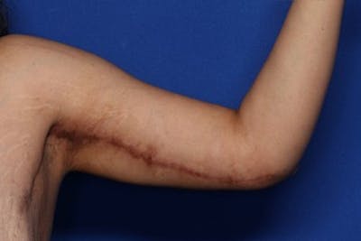 Arm Lift Before & After Gallery - Patient 349618 - Image 2