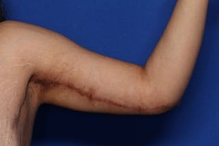 Arm Lift Before & After Gallery - Patient 349618 - Image 2