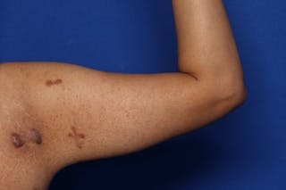 Arm Lift Before & After Gallery - Patient 349618 - Image 4