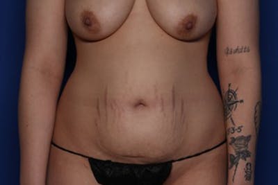 Liposuction Before & After Gallery - Patient 132404 - Image 1