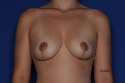 Breast Lift Before & After Gallery - Patient 333810 - Image 2