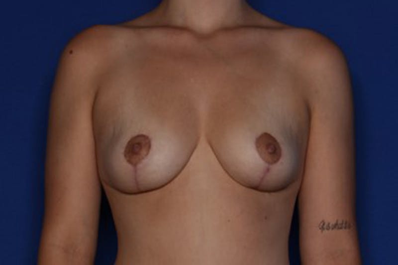 Breast Lift Before & After Gallery - Patient 333810 - Image 2
