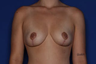 Breast Lift Before & After Gallery - Patient 333810 - Image 2