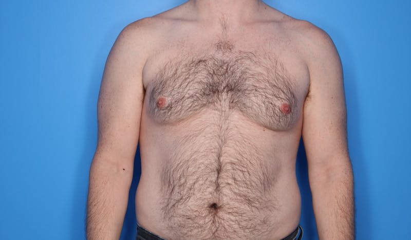 Gynecomastia (Male Breast Reduction) Before & After Gallery - Patient 389721 - Image 1