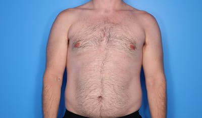 Gynecomastia (Male Breast Reduction) Before & After Gallery - Patient 389721 - Image 2