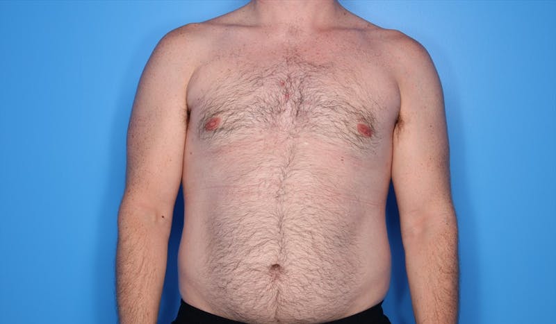 Gynecomastia (Male Breast Reduction) Before & After Gallery - Patient 389721 - Image 2